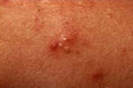 Picture of Acne white head pimple.