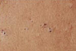 Acne picture - blackhead pimple.