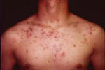 Acne picture on chest.