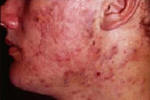 Acne picture on face.