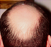 Hair loss before laser brush therapy.