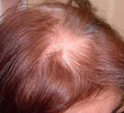 Hair loss before laser brush therapy.