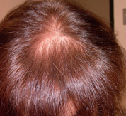 Hair loss after treatmet with Sunetics laser hair brush.