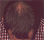 Hair loss after treatmet with Sunetics laser hair brush.