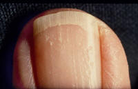 Finger nail psoriasis.