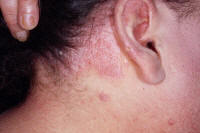 Scalp psoriasis and hair line psoriasis.