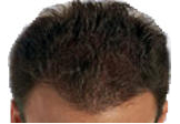 Hair loss after laser phototherapy.