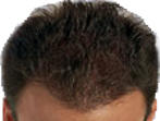 Hair loss after laser therapy.