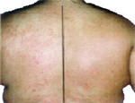 uvb phototherapy light treatment cleared psoriasis