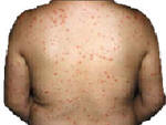 psoriasis picture before phothotherapy treatment