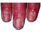 Psoriasis on fingers and under finger nails.