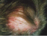 psoriasis on the scalp