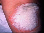psoriasis on the knee