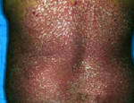 scale psoriasis