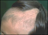 Picture of Trichotillomania hair loss disease