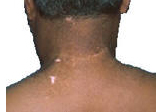 Vitiligo after UVB narrow band phototherapy.