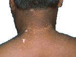 Vitiligo on skin after UV light therapy.