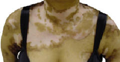 Vitiligo on chest