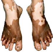 Vitiligo on feet