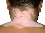 Vitiligo on skin.